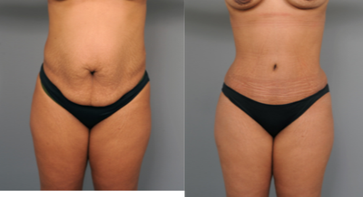 Case 2154 - 35-44 year old woman treated with Tummy Tuck