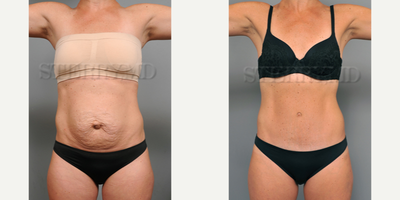 Case 2156 - 35-44 year old woman treated with Tummy Tuck