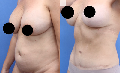 Case 2159 - Woman treated with Breast Augmentation, Breast Implants, Tummy Tuck
