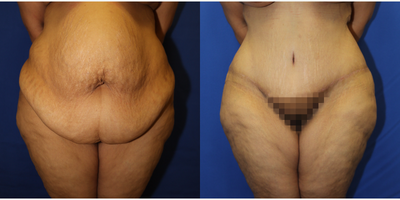Case 2160 - Tummy Tuck - 11 pounds of excess skin and fat removed