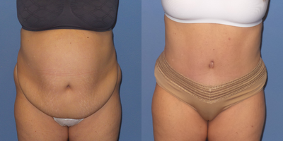 Case 2162 - 45-54 year old woman treated with Tummy Tuck