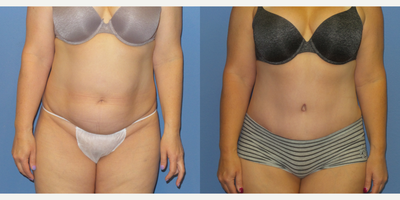 Case 2163 - 45-54 year old woman treated with Tummy Tuck