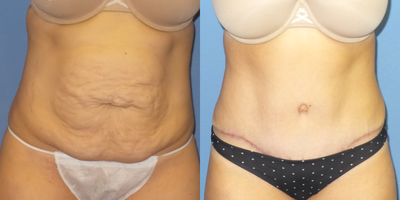 Case 2164 - 25-34 year old woman treated with Tummy Tuck