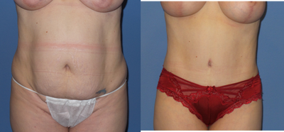 Case 2165 - 35-44 year old woman treated with Tummy Tuck