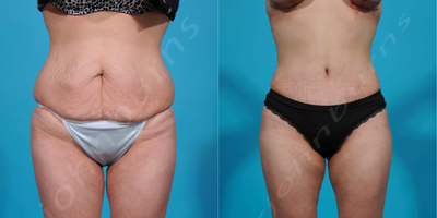 Case 2170 - 25-34 year old woman treated with Tummy Tuck