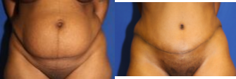 Case 2172 - Tummy Tuck 16 (front view)