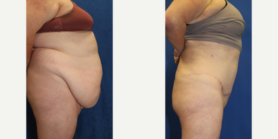 Case 2175 - 25-34 year old woman treated with Tummy Tuck