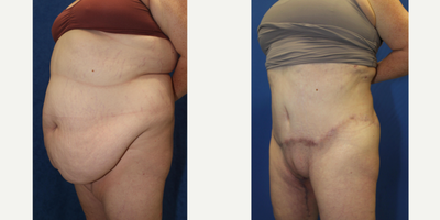 Case 2176 - 25-34 year old woman treated with Tummy Tuck