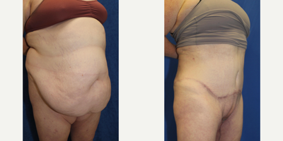 Case 2177 - 25-34 year old woman treated with Tummy Tuck