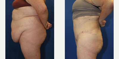 Case 2178 - 25-34 year old woman treated with Tummy Tuck