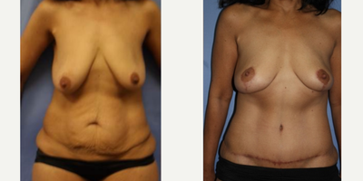Case 2180 - 45-54 year old woman treated with Tummy Tuck