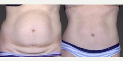 Case 2181 - 45-54 year old woman treated with Tumescent Liposuction