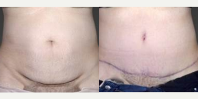 Case 2182 - 45-54 year old woman treated with Tummy Tuck