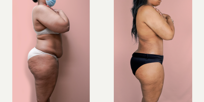 Case 2183 - 25-34 year old woman treated with Tummy Tuck