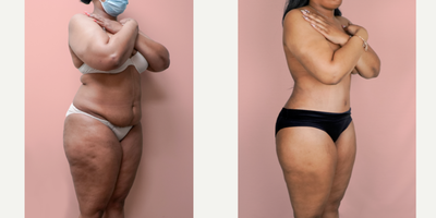 Case 2184 - 25-34 year old woman treated with Tummy Tuck