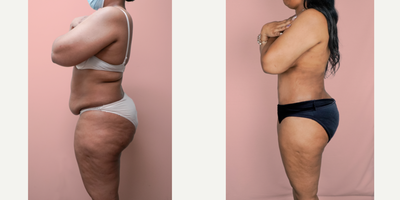 Case 2185 - 25-34 year old woman treated with Tummy Tuck