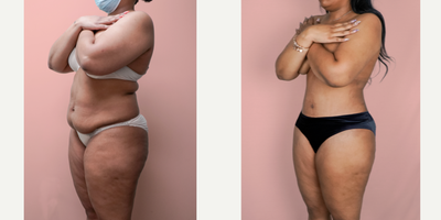 Case 2186 - 25-34 year old woman treated with Tummy Tuck