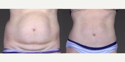 Case 2187 - 45-54 year old woman treated with Tummy Tuck