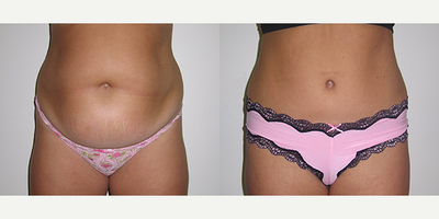 Case 2190 - 32 year old woman treated with Tummy Tuck