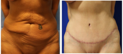 Case 2191 - Tummy Tuck 13