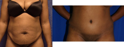 Case 2192 - Tummy Tuck 11