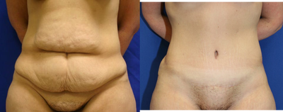 Case 2193 - Tummy Tuck 10
