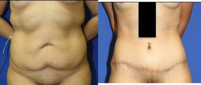Case 2194 - Tummy Tuck 9