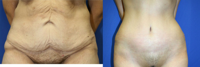 Case 2195 - Tummy Tuck 8