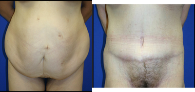 Case 2196 - Tummy Tuck 7