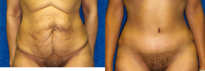 Case 2197 - Tummy Tuck 6