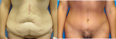 Case 2198 - Tummy Tuck 5