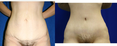 Case 2199 - Tummy Tuck 4