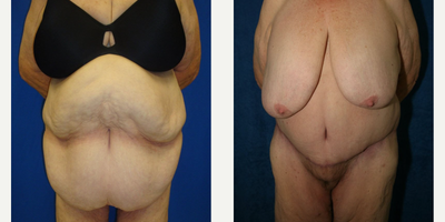 Case 22 - Woman treated with Tummy Tuck