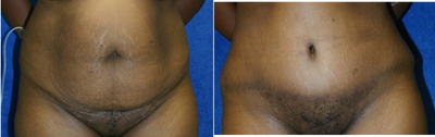 Case 2200 - Tummy Tuck 3
