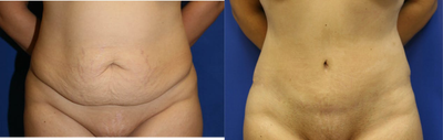 Case 2201 - Tummy Tuck 2