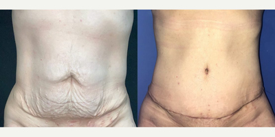 Case 221 - Woman treated with Tummy Tuck