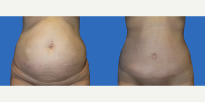 Case 2217 - 45-54 year old woman treated with Tummy Tuck