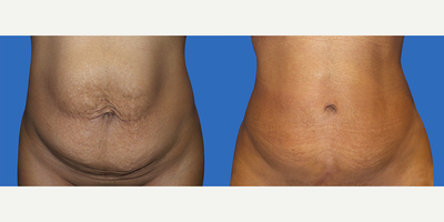 Case 2218 - 35-44 year old woman treated with Tummy Tuck