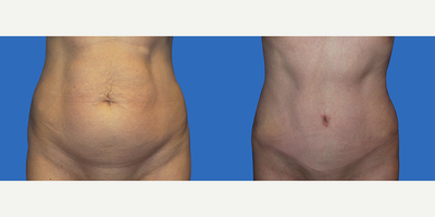Case 2219 - 35-44 year old woman treated with Tummy Tuck
