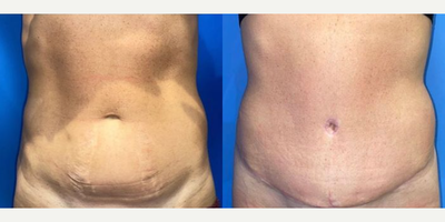 Case 222 - Woman treated with Tummy Tuck