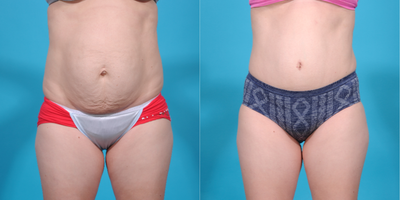 Case 2222 - 25-34 year old woman treated with Tummy Tuck