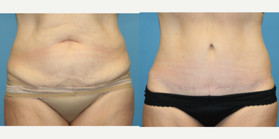 Case 2223 - 54 year old woman treated with Tummy Tuck
