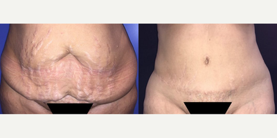 Case 223 - Woman treated with Tummy Tuck