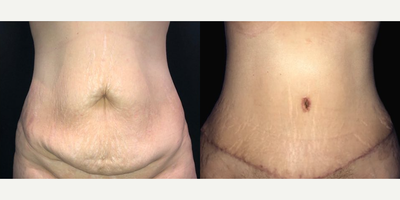 Case 224 - Woman treated with Tummy Tuck