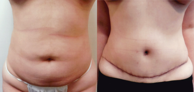 Case 2255 - 25-34 year old woman treated with Tummy Tuck