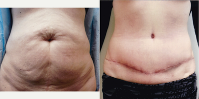 Case 2256 - 45-54 year old woman treated with Tummy Tuck