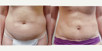 Case 2257 - 35-44 year old woman treated with Tummy Tuck