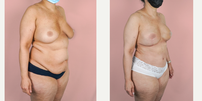 Case 2273 - 45-54 year old woman treated with Tummy Tuck