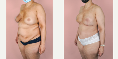 Case 2274 - 45-54 year old woman treated with Tummy Tuck