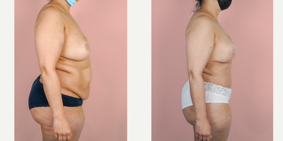 Case 2275 - 45-54 year old woman treated with Tummy Tuck